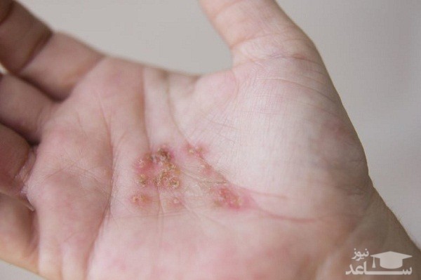 خارش درماتیت