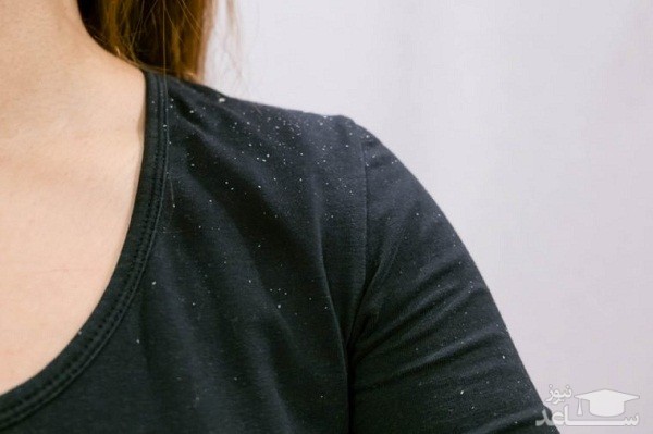 خارش شوره سر