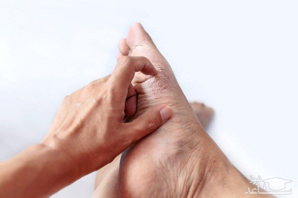 خارش قارچ پا