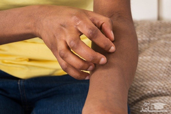 خارش پوست خشک