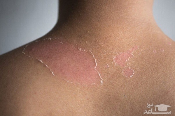 خارش آفتاب سوختگی