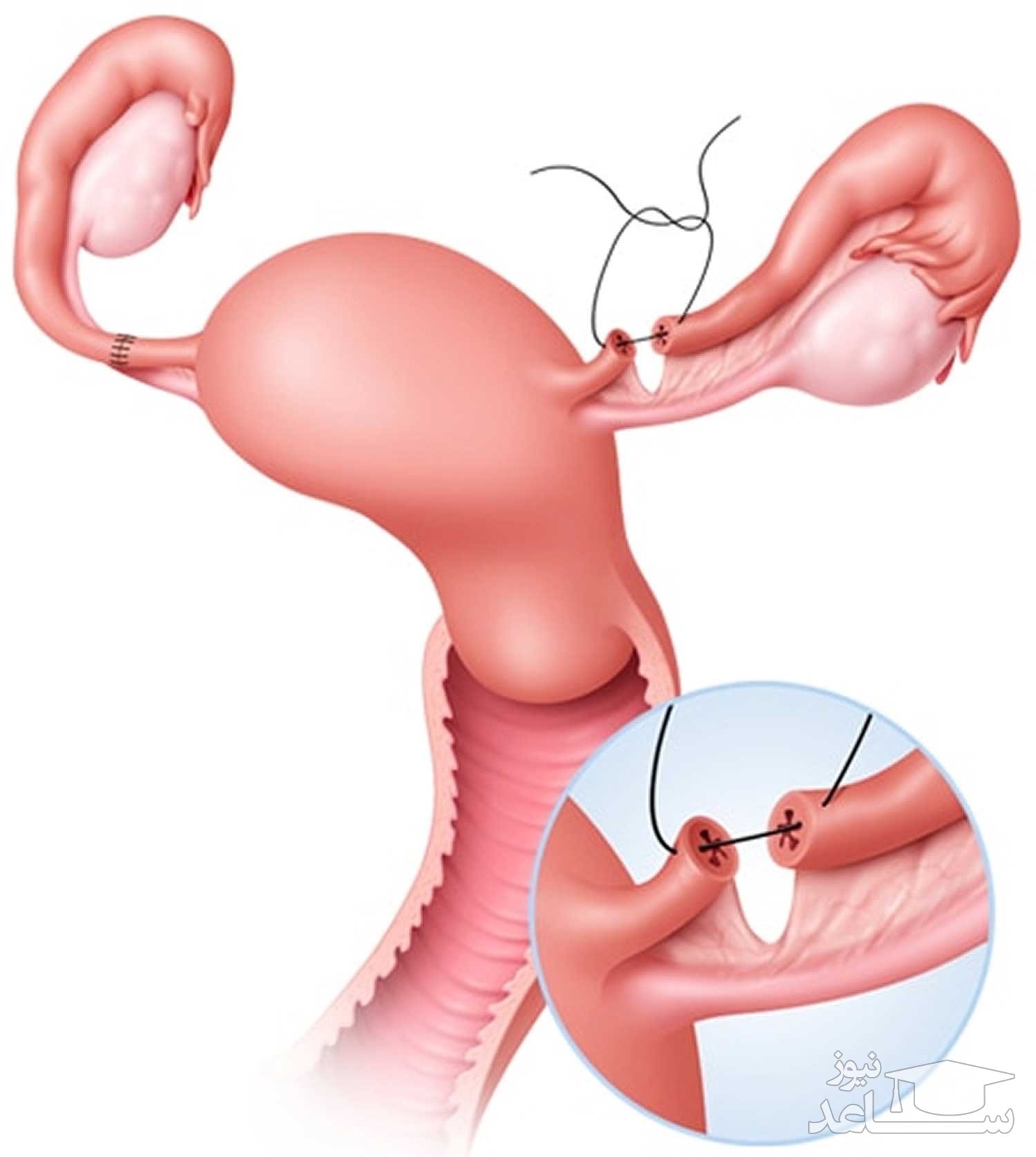 بستن لوله رحم برای جلوگیری از بارداری