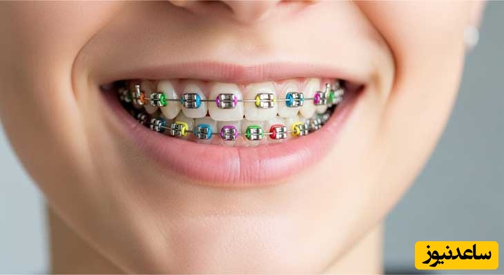 بیشتر از رنگ ارتودنسی مراقبت از دستگاه ارتودنسی مهم است!