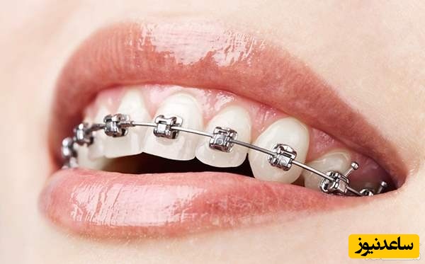 عوارض ارتودنسی