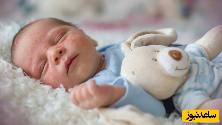دلایل برفک دهان نوزاد چیست؟
