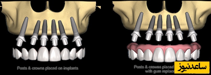 مزایای روانی دندان مصنوعی بر پایه 6 ایمپلنت