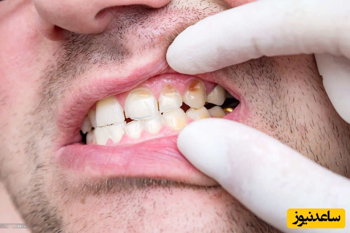 چگونه ونیرهای دندان، دندانهای خرگوشی را اصلاح می کنند؟