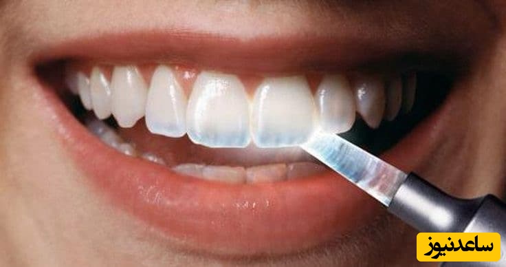 4 مشکل رایج دندان ها و بهترین راه درمان آن