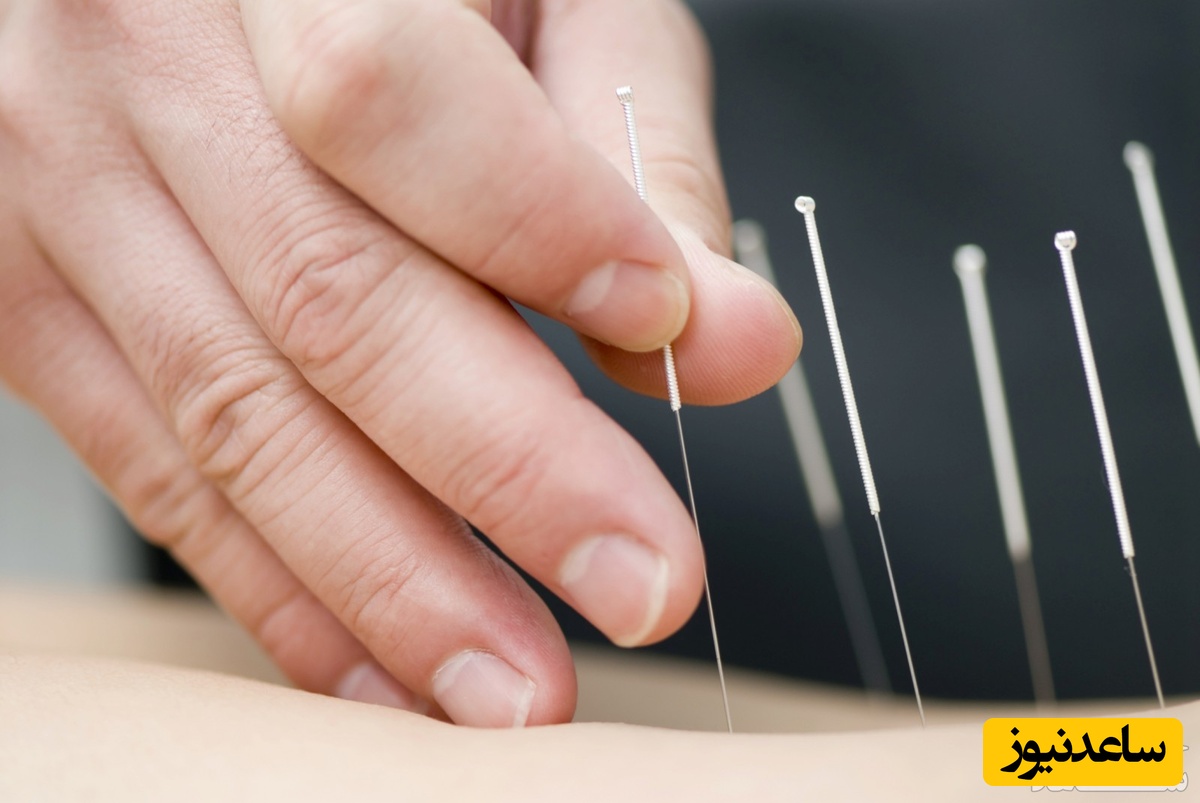 طب سوزنی در بارداری چه مزایا و معایبی دارد؟