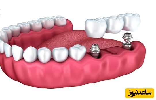 کاشت دندان به روش پل ثابت چگونه است؟