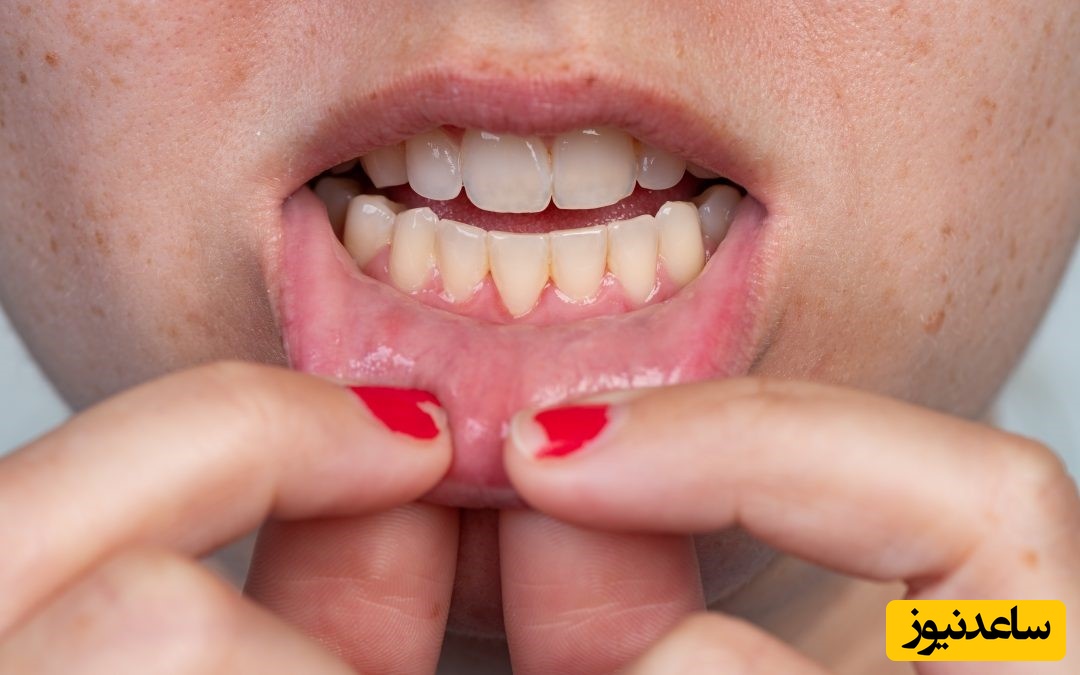 انواع جراحی لثه چیست؟