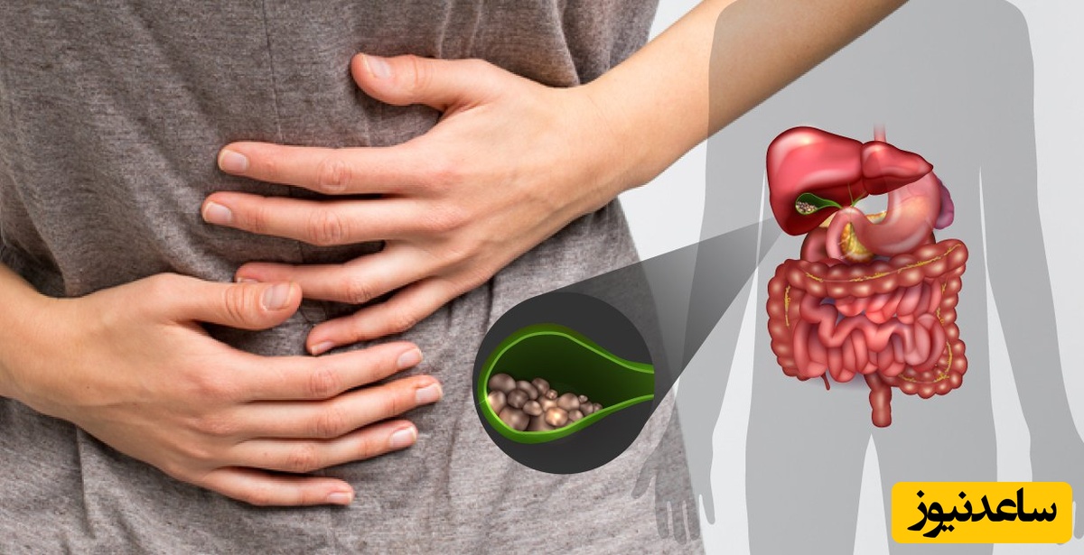 سنگ کیسه صفرا چگونه ایجاد می‌شود؟ و زنان در معرض خطر بیشتری هستند+ ویدئو
