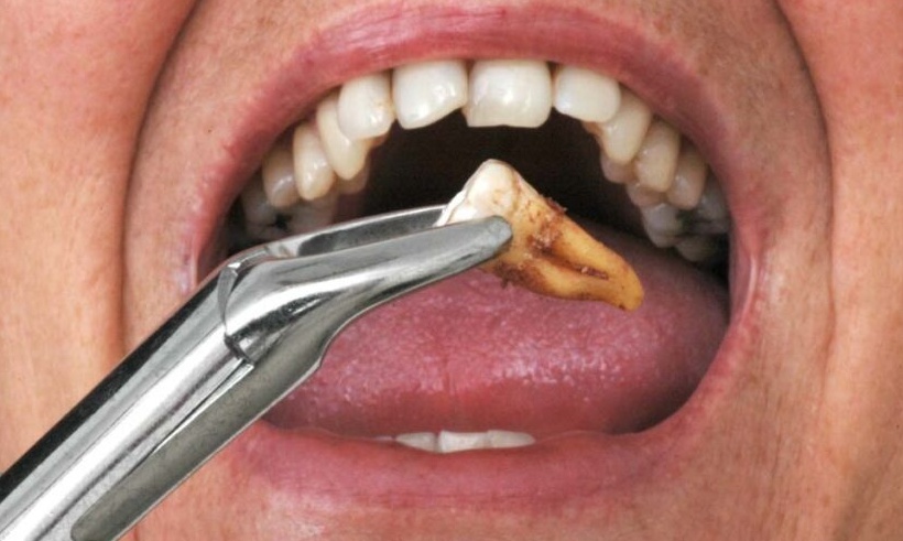 انواع دندان عقل و مزایای کشیدن آن