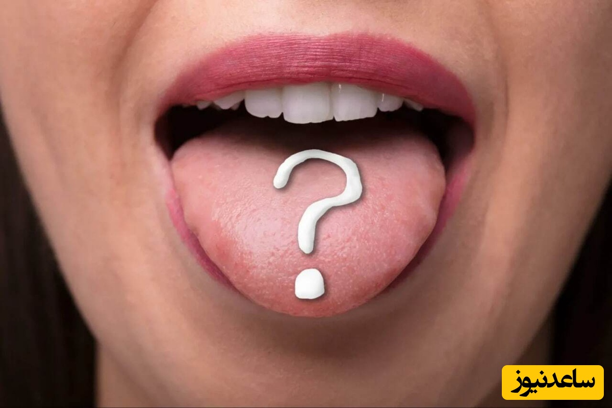  لکه‌های سفید روی دندان‌ها را چگونه از بین ببریم؟