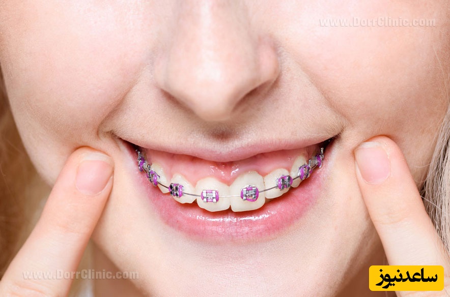 چه عوامل اجتماعی منجر به درمان ارتودنسی می شوند؟