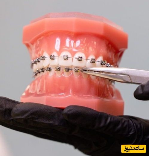 نحوه ی انتخاب یکی از دستگاه های ارتودنسی که مناسب دندان های شماست!