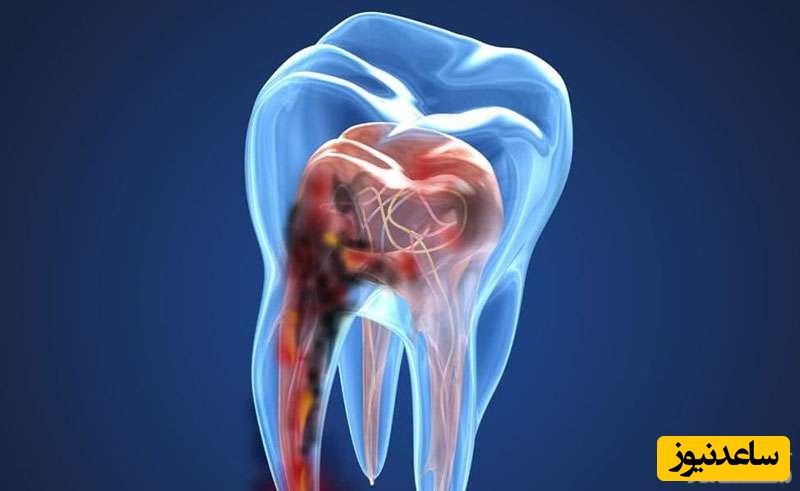برای دندان درد شدید چه باید کرد؟