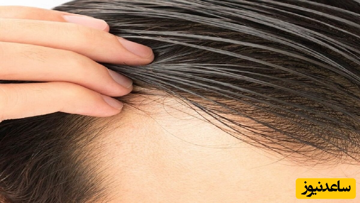 چند روش کاربردی خانگی برای درمان چربی موی سر که باید یاد بگیرید