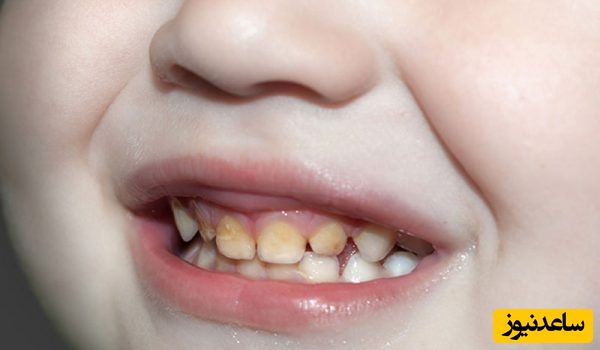 درمان تغییر رنگ دندان ها در کودک