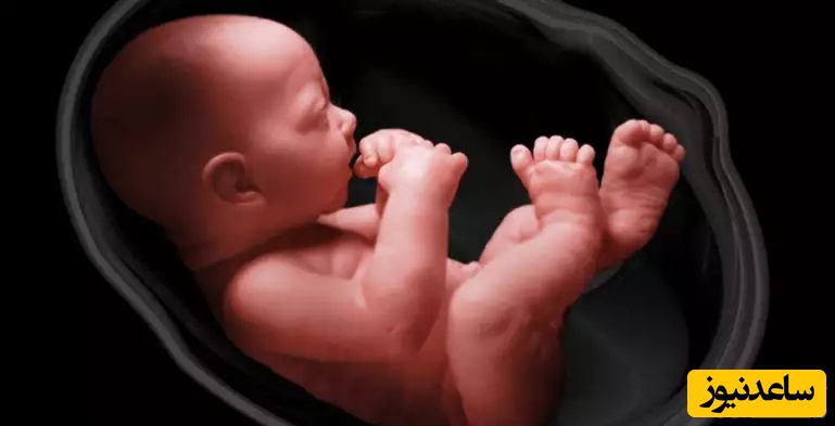 علل سندرم باند آمنیوتیک در دروان بارداری و روش های درمان