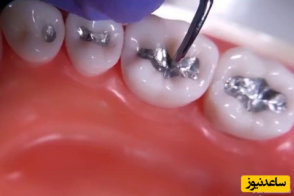 اگر قصد پر کردن دندان با آمالگام دارید، بخوانید