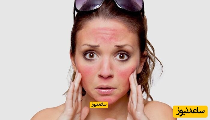 پوستر آفتاب سوختگی