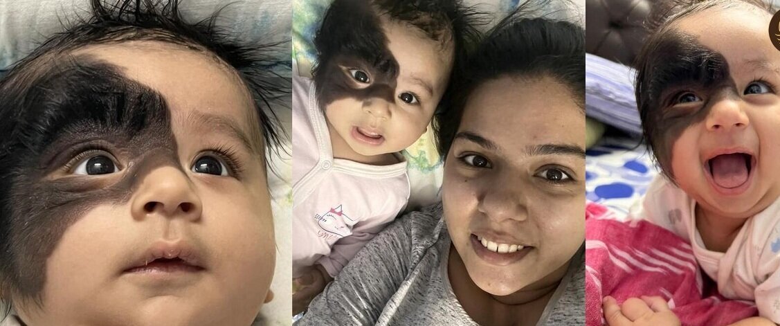 (تصاویر) تولد نوزادی با خال غول‌پیکر مودار روی صورتش