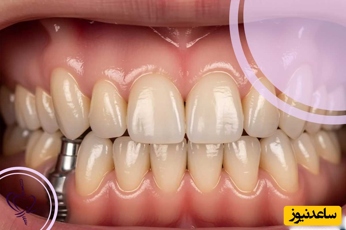 بریج یا ایمپلنت دندان کدام بهتر است؟