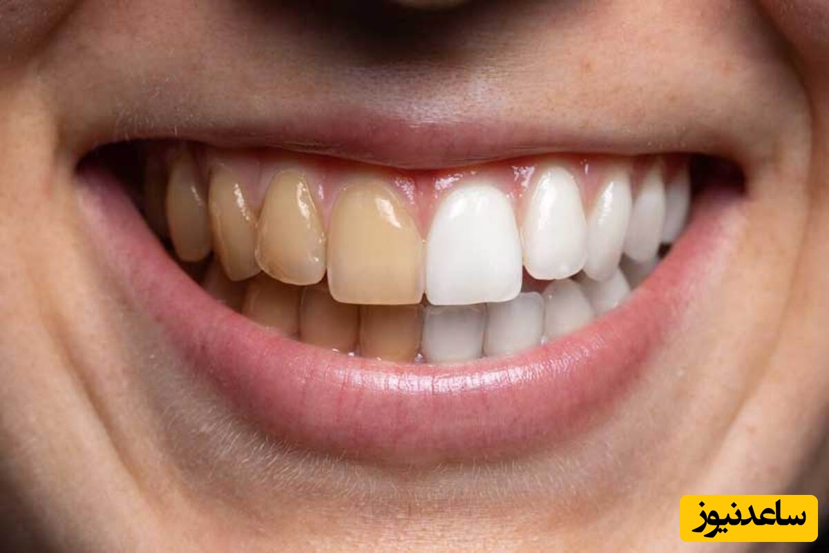 استفاده از پوست موز برای سفیدی دندان