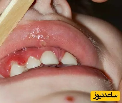دلایل التهاب و قرمزی لثه در کودکان چیست؟