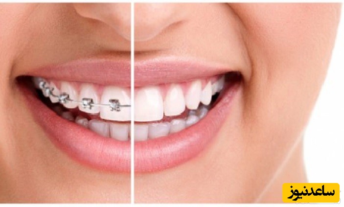 تاثیر ارتودنسی بر بینی