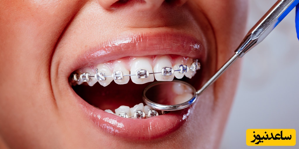 مهم‌ترین سوالات رایج درباره ارتودنتیست‌ها