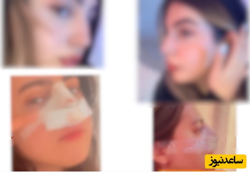 رونق  جراحی‌های معکوس در ایران/ وقتی همان بینی‌های عروسکی شده را قوزدار می‌کنند+ عکس