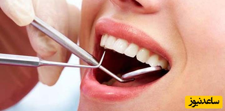 لمینت دندان، برای شما مناسب است یا خیر؟