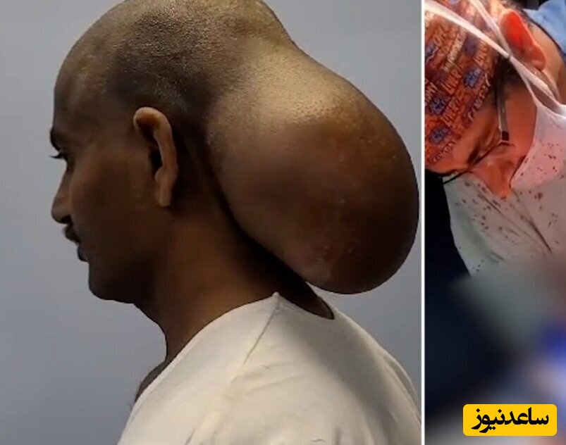 (عکس) خارج کردن غده‌ای به بزرگی طالبی از سر یک مرد