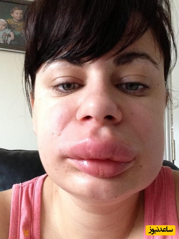 ورم ناگهانی لب؛ علل و عوامل محرک