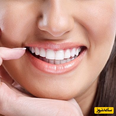 لیفت لثه + نکات مهم