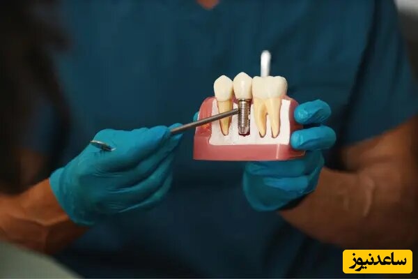 جای خالی دندانی که کشیده اید را چگونه میتوانید پر کنید؟