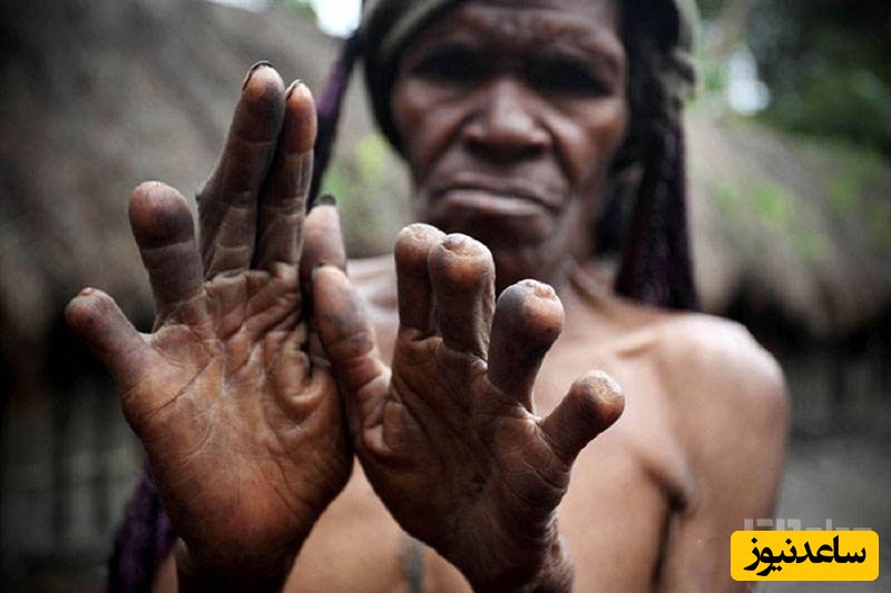 (فیلم) ساکنین این روستا انگشت‌هایشان را برای فراموشی غم قطع می‌کنند! رسوم عجیب دنیا را ببینید