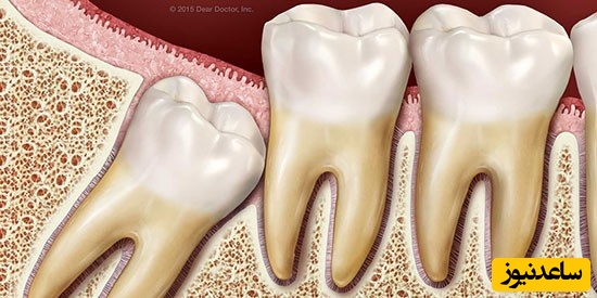 عفونت بعد از کشیدن دندان عقل