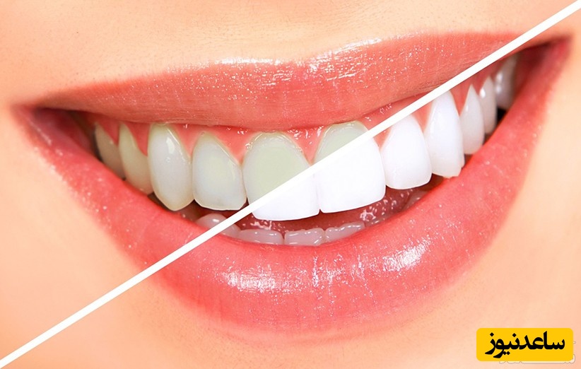 بهترین روش سفید کردن دندان