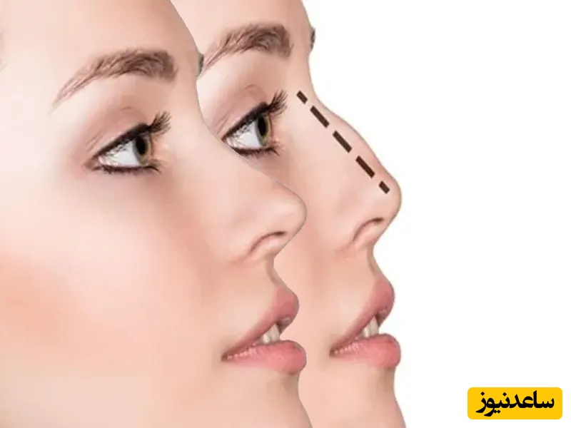 چگونه جای بخیه بعد از عمل بینی را در خانه کمرنگ کنیم؟