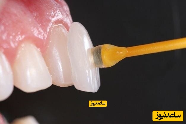 رپورتاژ لمینت بهتر است یا کامپوزیت؟