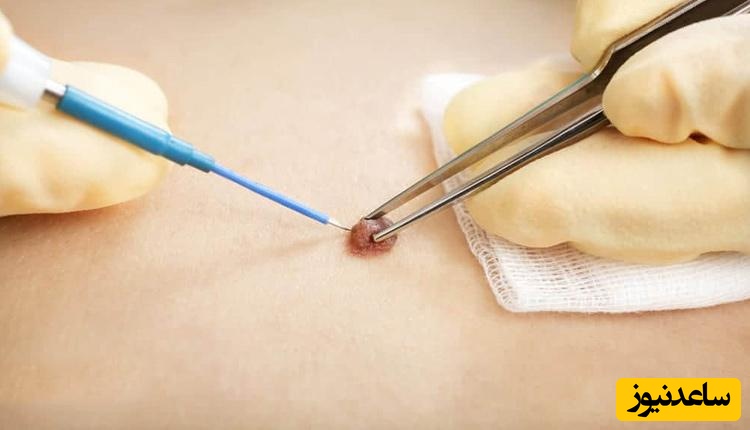 درمان قطعی زگیل تناسلی: روش‌های موثر برای مقابله با ویروس HPV