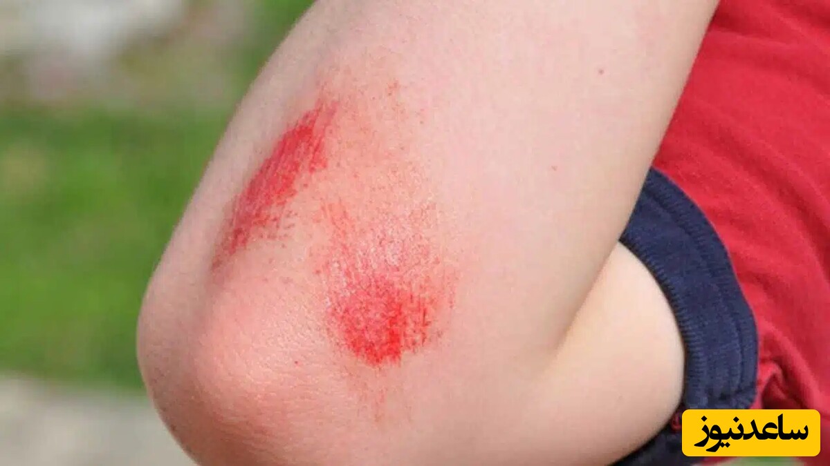 دیدن زخم در خواب چه تعبیری دارد؟ / تعبیر خواب زخم