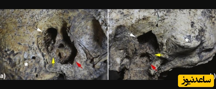 کشف جمجمه‌ای با قدیمی‌ترین شواهد جراحی گوش