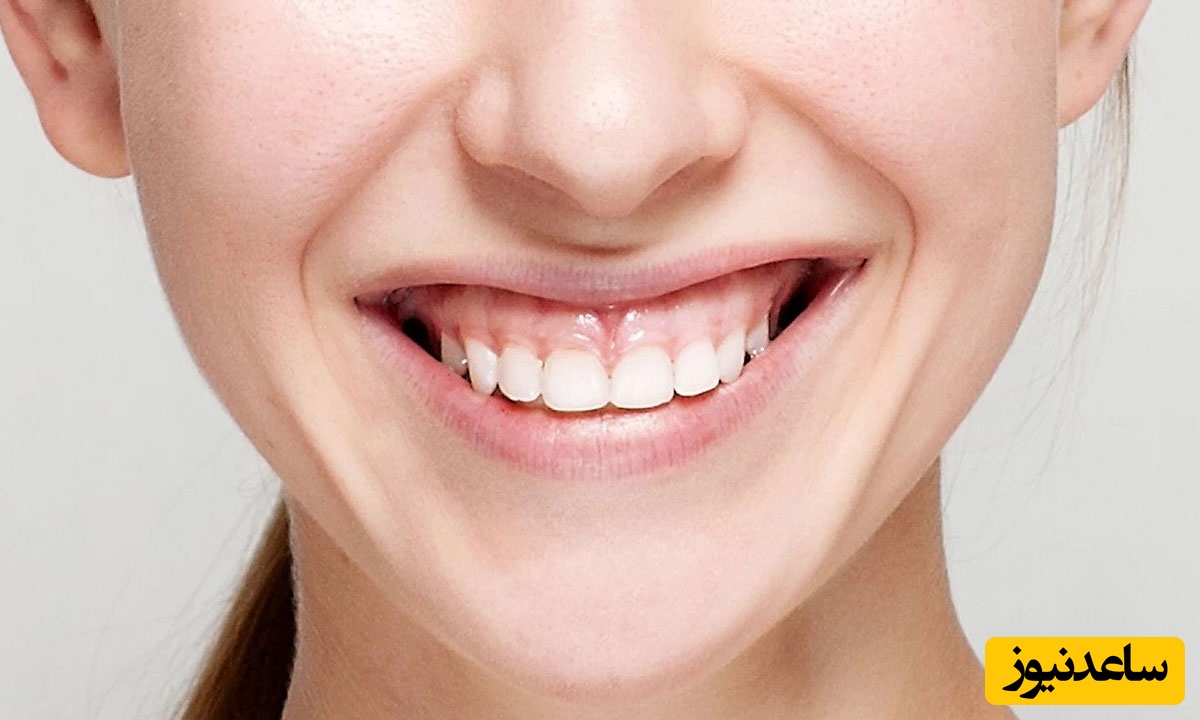 انواع لبخند لثه ای کدامند؟