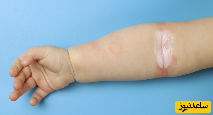 - استفاده از لوسیون کالامین