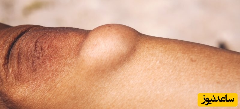 علل ایجاد لیپوما در بدن چیست؟