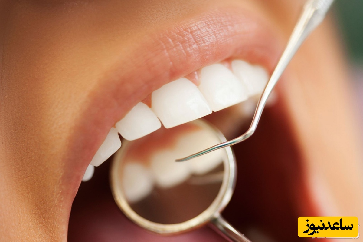 آبسه دندان و چگونگی ایجاد آن